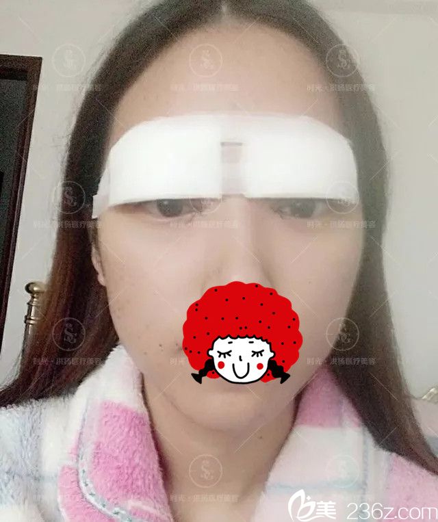 刚做完眼综合整形术后恢复