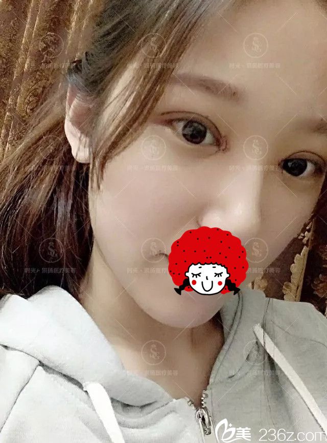 拆掉纱布第二天眼部恢复