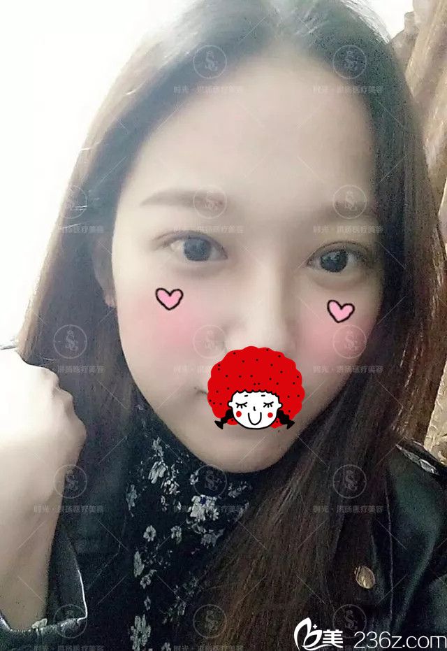 术后6天拆线眼综合恢复