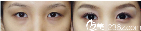 北京上上相医疗美容医院双眼皮效果