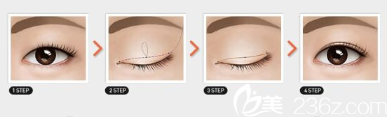 韩式微创双眼皮手术方法