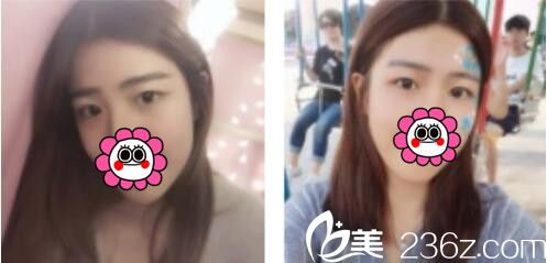 韩国BY整形外科蔡秀旭韩式双眼皮真人案例术前照 韩国BY整形外科蔡秀旭韩式双眼皮真人案例术前照