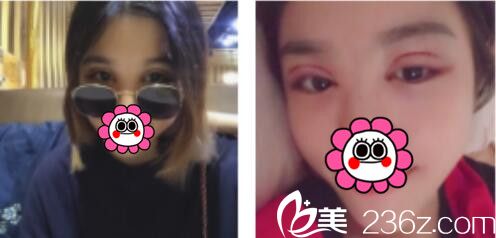 韩国BY整形外科蔡秀旭韩式双眼皮真人案例术后第三天 韩国BY整形外科蔡秀旭韩式双眼皮真人案例术后第三天