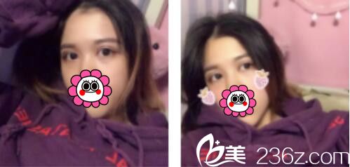 韩国BY整形外科蔡秀旭韩式双眼皮真人案例术后第七天 韩国BY整形外科蔡秀旭韩式双眼皮真人案例术后第七天