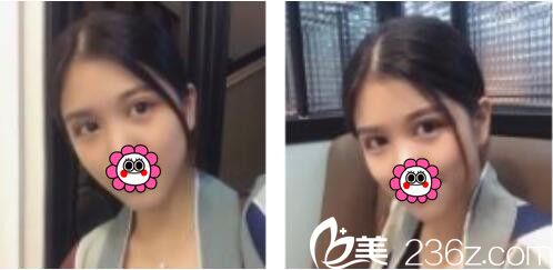 韩国BY整形外科蔡秀旭韩式双眼皮真人案例术后一个月 韩国BY整形外科蔡秀旭韩式双眼皮真人案例术后一个月