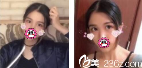 韩国BY整形外科蔡秀旭韩式双眼皮真人案例术后两个月 韩国BY整形外科蔡秀旭韩式双眼皮真人案例术后两个月