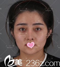 北京上上相医疗美容面部脂肪填充修复术前照 北京上上相医疗美容面部脂肪填充修复术前照