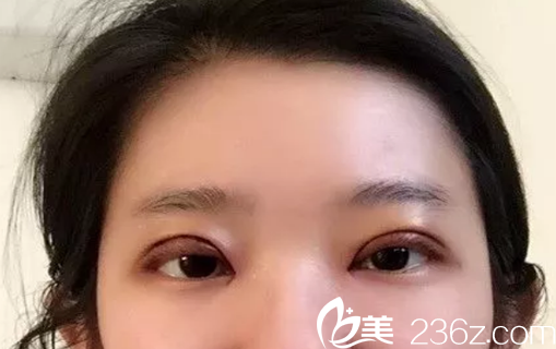 陈浩韩式微创切开双眼皮术后第5天照片