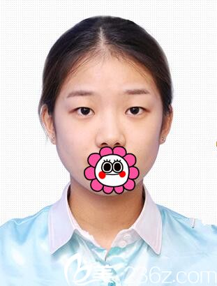 吉林市中妍双眼皮手术案例 吉林市中妍双眼皮手术案例