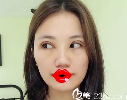 在杭州诠昕做双眼皮5天<span style=