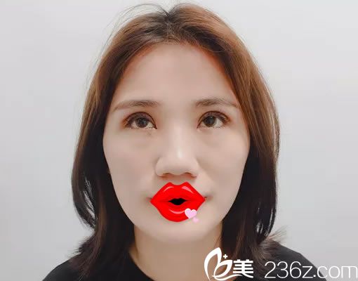 找周做双眼皮7天恢复照