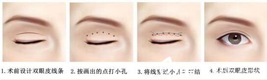 吉林市中妍埋线双眼皮手术方法 吉林市中妍埋线双眼皮手术方法