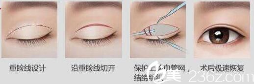 吉林市中妍全切双眼皮手术方法 吉林市中妍全切双眼皮手术方法