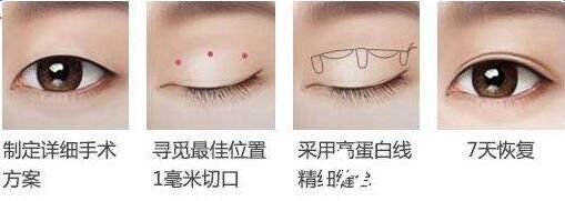 吉林市中妍韩式双眼皮手术方法 吉林市中妍韩式双眼皮手术方法