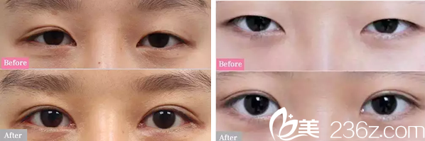 广元美华整形美容医院双眼皮案例 广元美华整形美容医院双眼皮案例