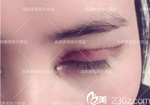 杨迪帕克双眼皮术后即刻特写 杨迪帕克双眼皮术后即刻特写