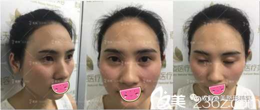 <!--<i data=20240703-sp></i>-->双眼皮术前照片 <!--<i data=20240703-sp></i>-->双眼皮术前照片