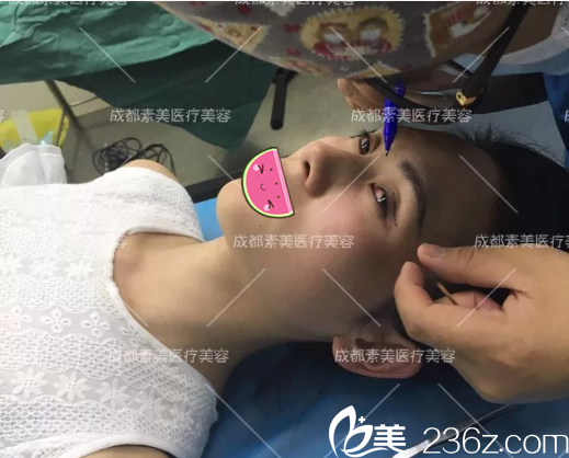 <!--<i data=20240703-sp></i>-->杨迪双眼皮术前设计 <!--<i data=20240703-sp></i>-->杨迪双眼皮术前设计