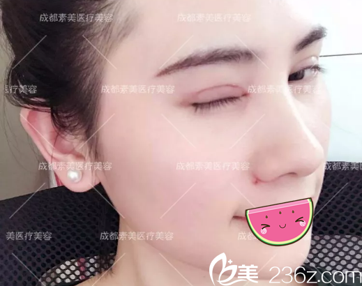 杨迪切开双眼皮术后半个月美照 杨迪切开双眼皮术后半个月美照