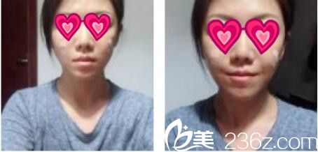 上海薇琳医疗美容医院丁晓东面部线雕提升真人案例术后第二天