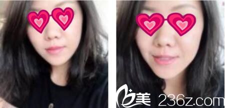 上海薇琳医疗美容医院丁晓东面部线雕提升真人案例术后第十天