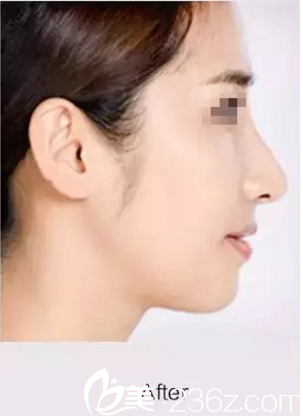 想改善驼峰鼻？在松原铭医做达拉斯综合隆鼻后拥有娇翘美鼻