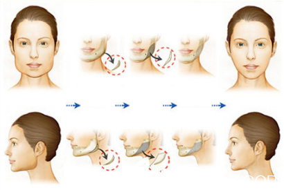 面部轮廓下颌角手术方法
