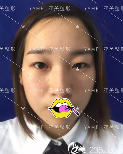 作双眼皮手术前照片 作双眼皮手术前照片