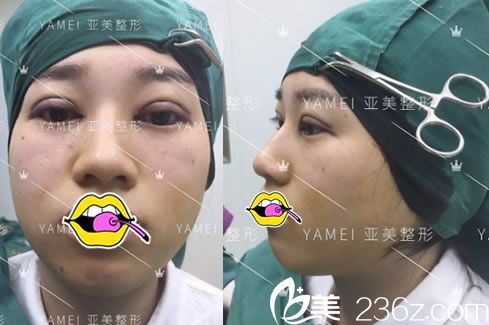 在亚美刚做完双眼皮的照片 在亚美刚做完双眼皮的照片