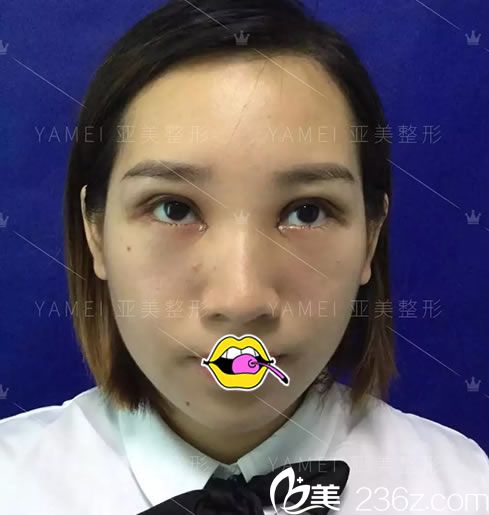 在亚美做完双眼皮术后1天恢复照 在亚美做完双眼皮术后1天恢复照