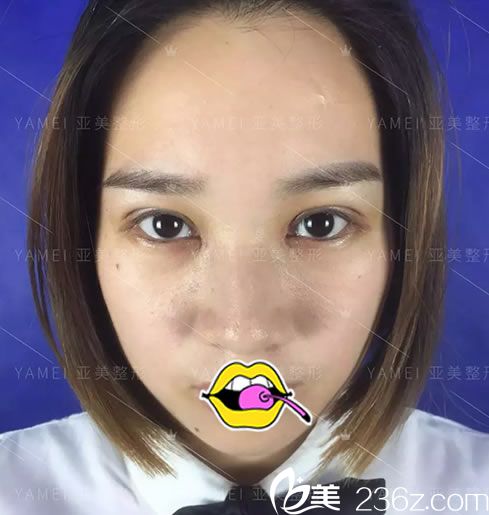 金华亚美胡华兵双眼皮<span style= 金华亚美胡华兵双眼皮<span style=