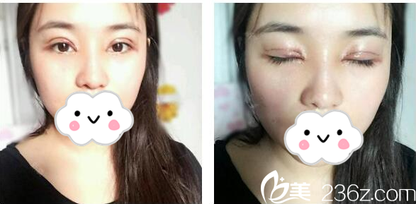 珠海九龙整形美容医院梁富荣医生做的双眼皮案例两天效果图 珠海九龙整形美容医院梁富荣医生做的双眼皮案例两天效果图