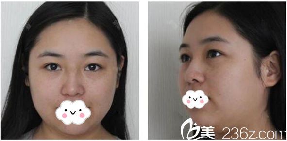 双眼皮术前照片 双眼皮术前照片