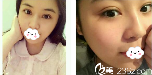 珠海哪里割双眼皮好?珠海九龙整形美容医院梁富荣医生双眼皮案例分享 珠海哪里割双眼皮好?珠海九龙整形美容医院梁富荣医生双眼皮案例分享