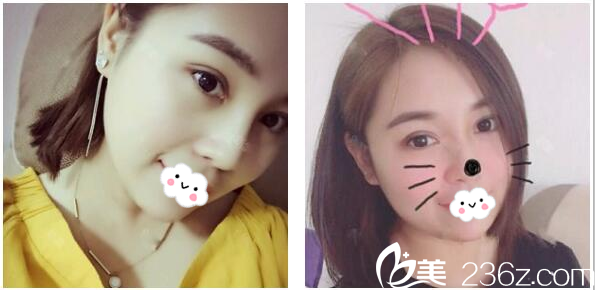 珠海哪里割双眼皮好？朋友推荐我找珠海九龙整形美容医院做的切开双眼皮