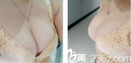 上海一美整形外科医院邹丽剑自体脂肪隆胸真人案例术后二十二天