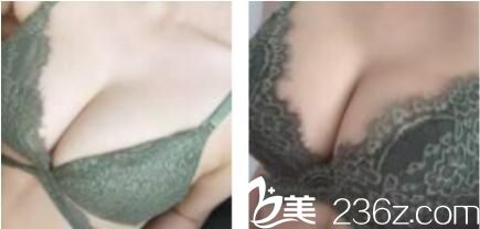 上海一美邹丽剑建议我做自体脂肪隆胸，三个月过去了效果特别好