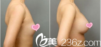 StarM整形外科隆胸案例 StarM整形外科隆胸案例
