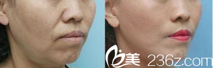 StarM整形外科去法令纹案例 StarM整形外科去法令纹案例