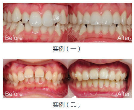 佛山曙光金子整形美容医院刘晓勤牙齿矫正案例