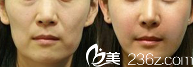韩国Star M整形外科医院自体脂肪填充苹果肌案例 韩国Star M整形外科医院自体脂肪填充苹果肌案例