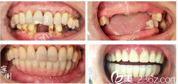 合肥壹加壹牙齿种植案例前后对比照 合肥壹加壹牙齿种植案例前后对比照