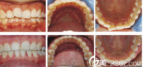 合肥壹加壹牙齿矫正案例恢复过程图 合肥壹加壹牙齿矫正案例恢复过程图