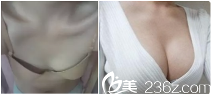 韩国Star M整形外科医院脂肪丰胸前后对比效果