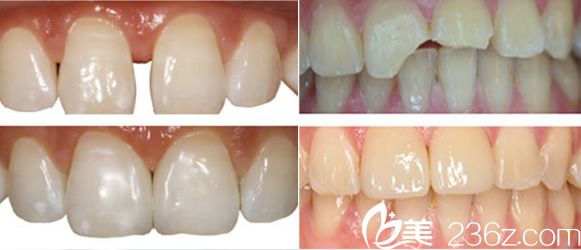 合肥壹加壹牙齿美学修复前后对比图片 合肥壹加壹牙齿美学修复前后对比图片