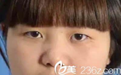 在泉州亿星整形医院做双眼皮和隆鼻术前照 在泉州亿星整形医院做双眼皮和隆鼻术前照