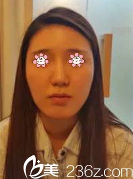 去韩国NEO整形外科前的我 去韩国NEO整形外科前的我