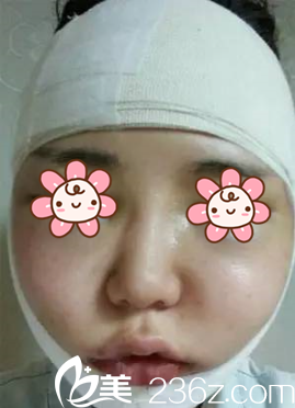 韩国NEO整形颧骨缩小术后第2天 韩国NEO整形颧骨缩小术后第2天