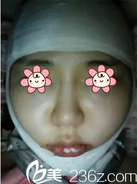 韩国NEO整形医院下颌角整形术后第3天 韩国NEO整形医院下颌角整形术后第3天