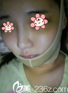 朴正日院长垫下巴术后一周 朴正日院长垫下巴术后一周